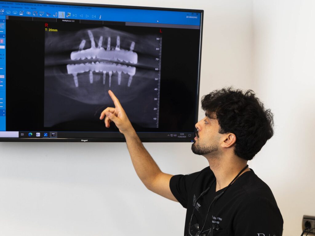 Radiografía de rehabilitación sobre implantes dentales