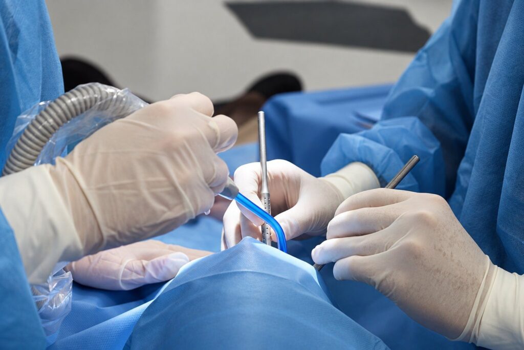 Cirugía periodontal en Bucodontos