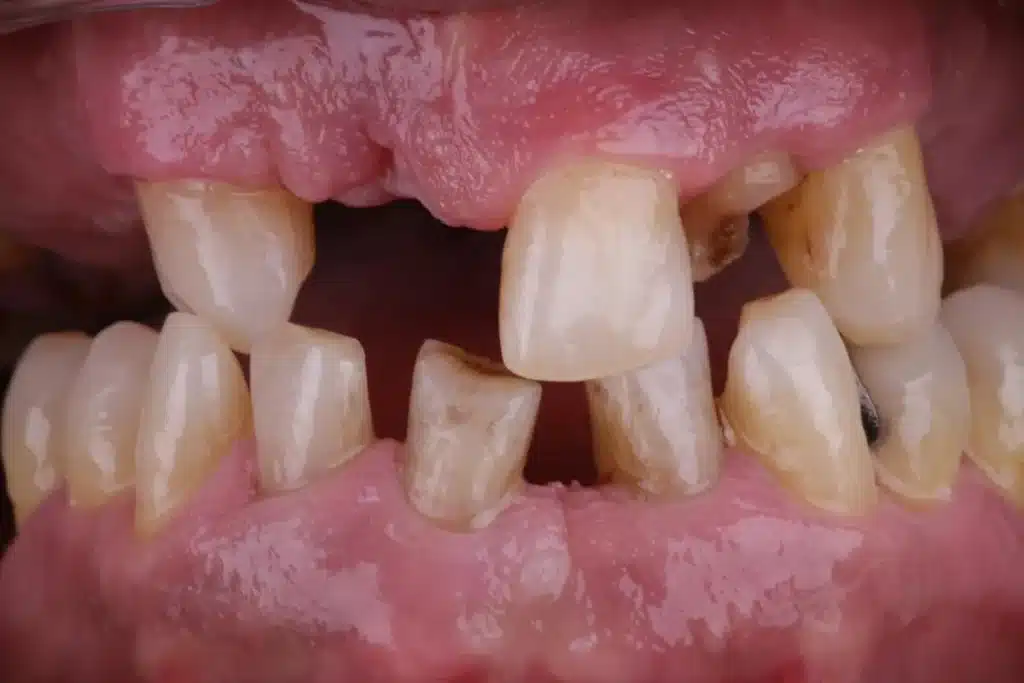 Antes de la rehabilitación completa con implantes dentales en Bucodontos