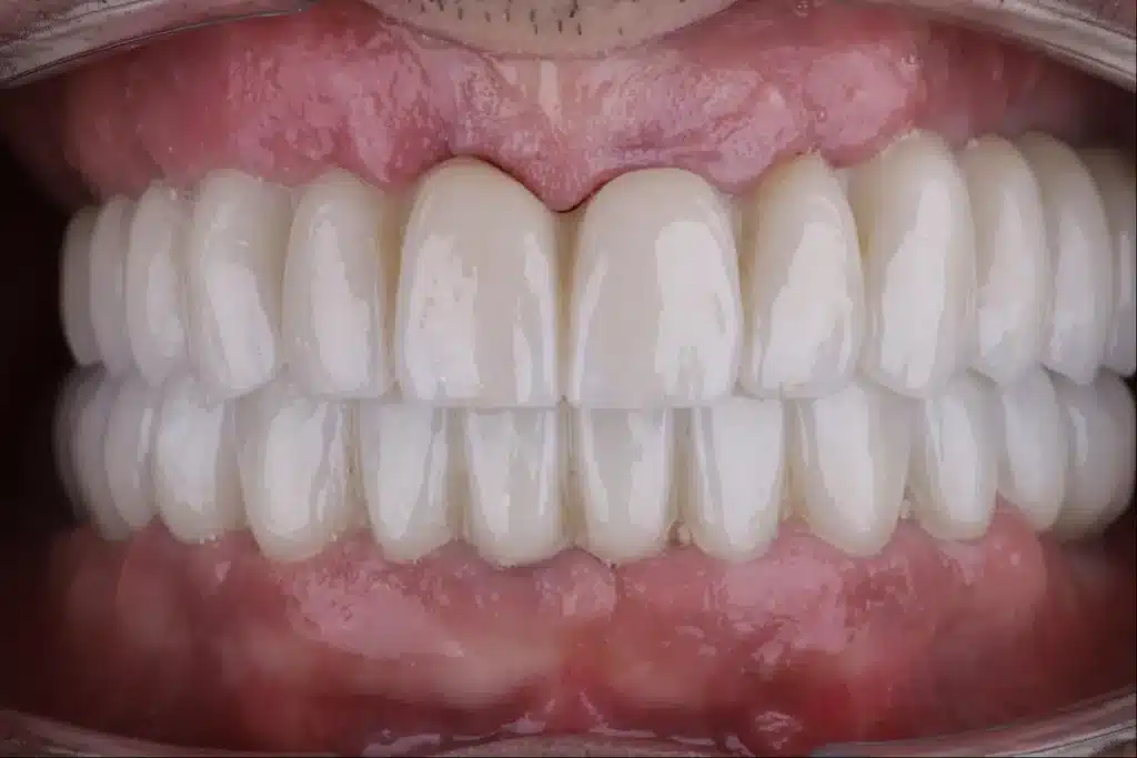 Después de la rehabilitación completa con implantes dentales en Bucodontos
