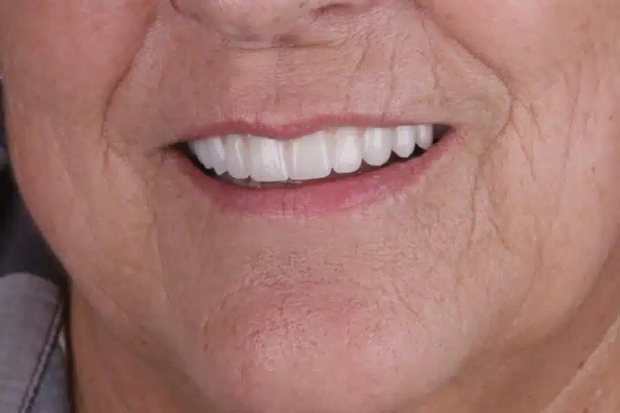 Sonrisa de una paciente tras su tratamiento en Bucodontos